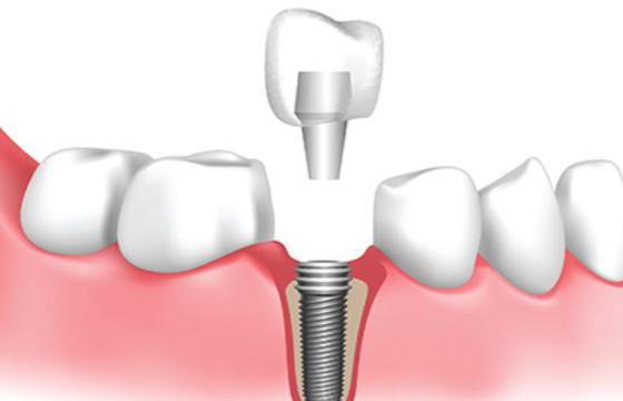 Single Dental Implant