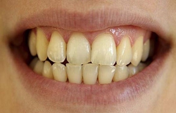 Stained Discolored Teeth