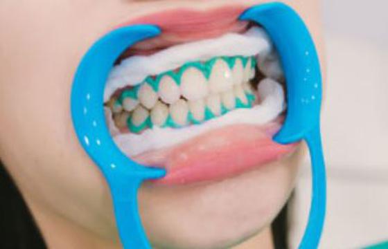 Teeth Whitening