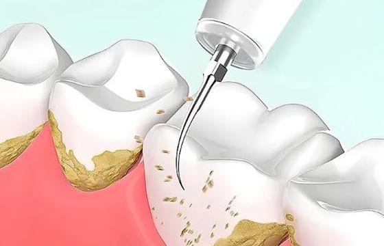 Tooth Stone Cleaning