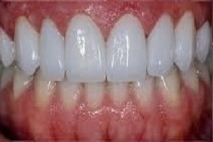 Zirconia Veneers After