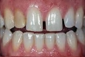 Zirconia Veneers Before