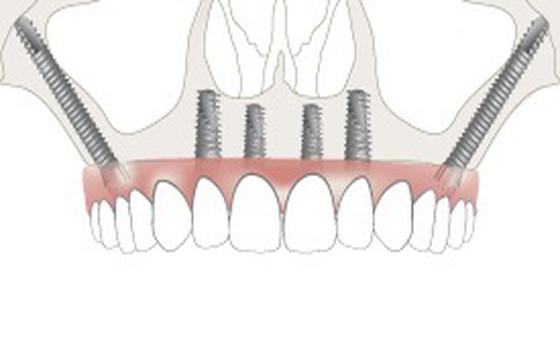 Zygoma Implants