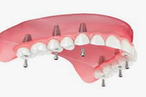 All on 6 Dental Implants