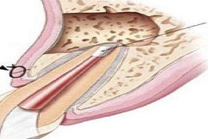 Apical Resection