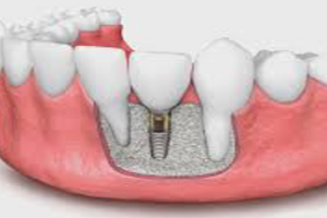 Bone Grafting