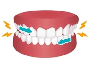 Bruxism