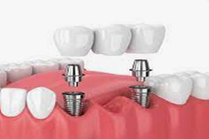 Dental Bridges