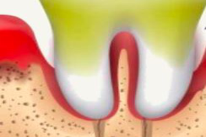 Gum Disease Treatment