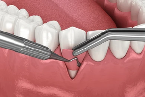 Gum Graft Surgery