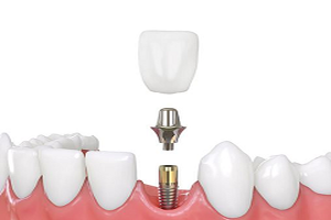 Dental Implants