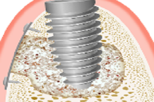 Osseointegration