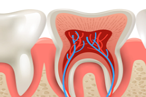 Root Canal Treatment