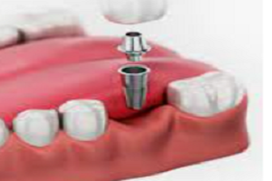 Single Dental Implant