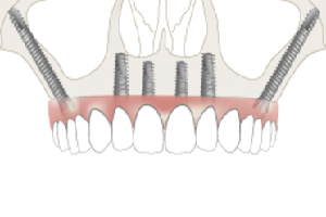 Zygoma Implants