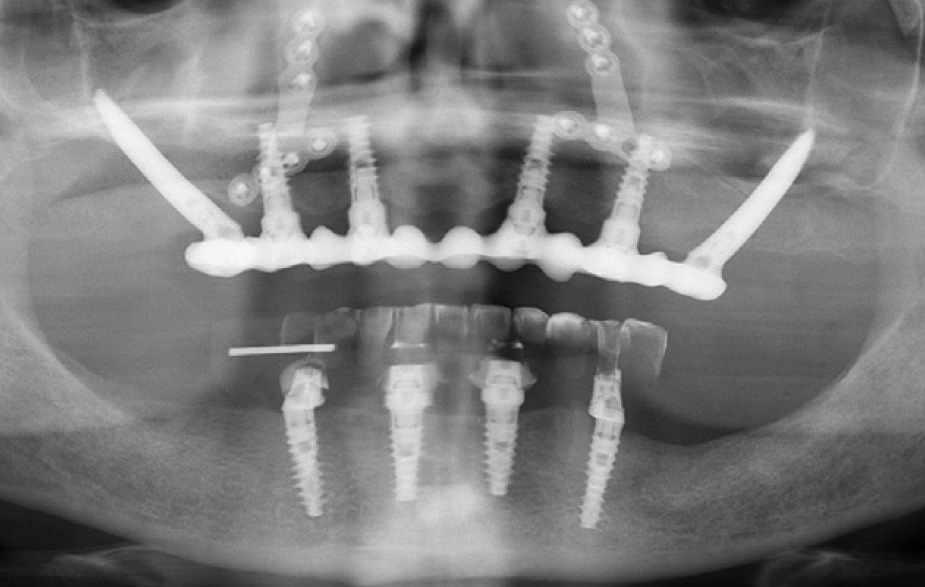 All on 4 dental implants in turkey