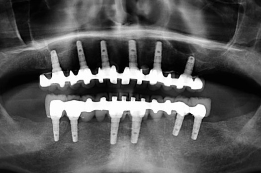 All-on-6 Implants in Turkey