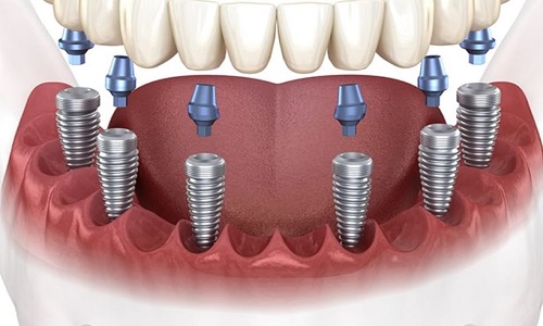 Dental Implants Turkey